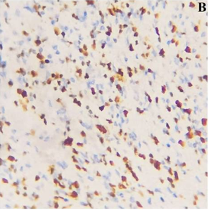 Role of Ki-67 as an Adjunct to Histopathological Diagnosis in the Grading of Astrocytic Tumors