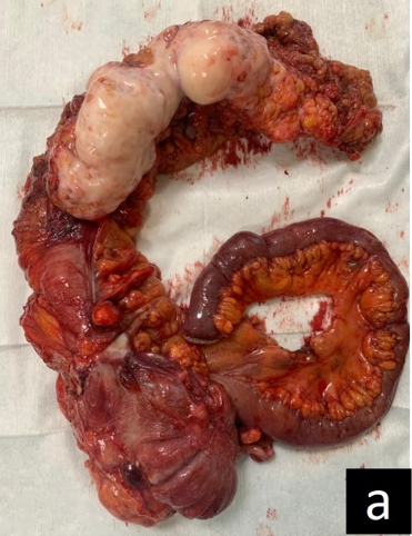 Primary Dedifferentiated Liposarcoma of the Colon - Report of a Rare Case with Review of Literature