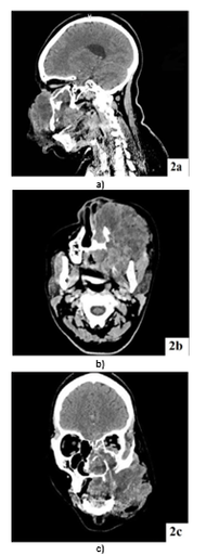 Maternal and Fetal Outcomes in Pregnancies Affected by Osteosarcoma of the Jaw: A Case Report