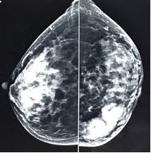 Adenocarcinoma Lung Diagnosed as a &lsquo;Synchronous Primary Double Malignancy&rsquo; in Treated Case of Carcinoma of Breast: Case Report