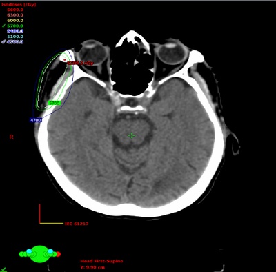 Primary Cutaneous Mucinous Adenocarcinoma of Facial Region Treated with Multimodality Therapy: Case Series of Rare Malignancy