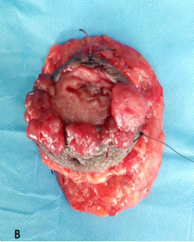 Metachronous Carcinoma at Colostomy Site Post Abdominoperineal Resection &ndash; A Rare Presentation Case Report