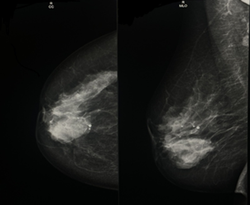 Adenoid Cystic Carcinoma of the Breast: A Case Report