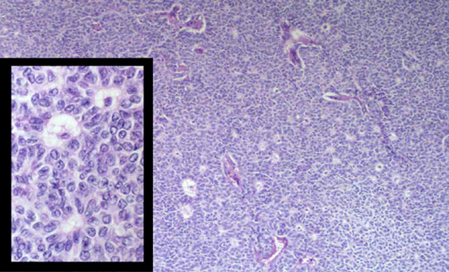 Anatomopathological and Epidemiological Profile of Granulosa Tumors of the Ovary: About 9 Cases