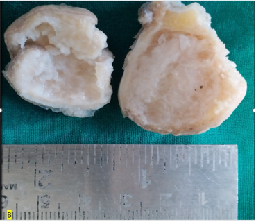 Chondroblastoma in a Distal Phalanx of the Great Toe &ndash; A Rare Case Report